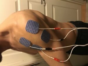 Genoptræning af hånd, arm og skulder med el-stimulation